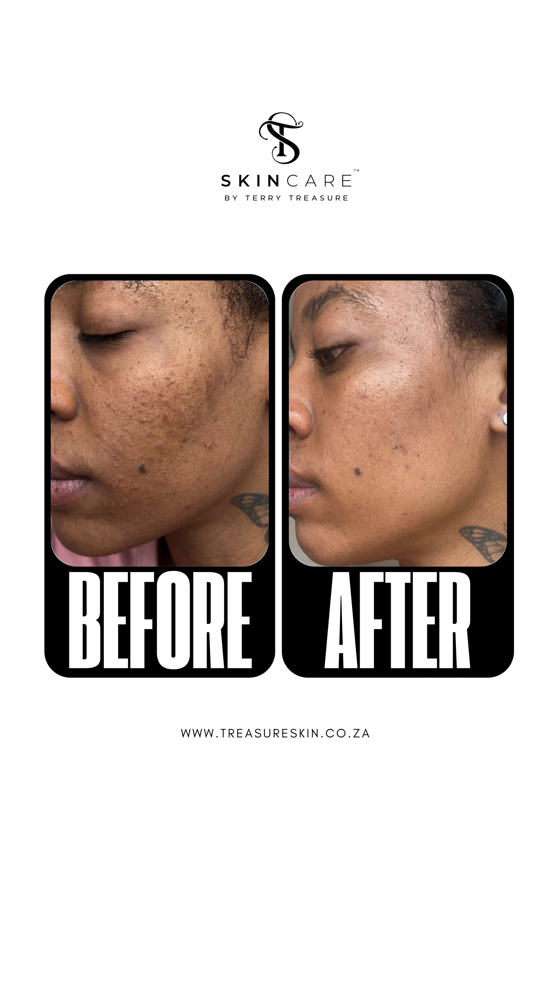 ACNE FACIAL CLEANSER